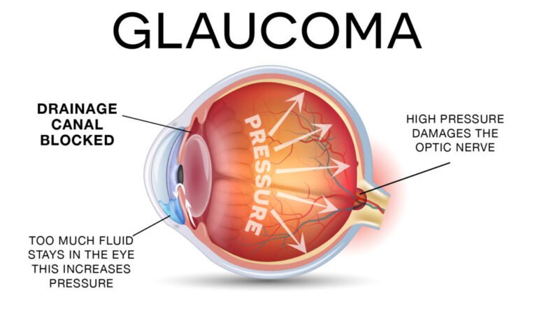 GLAUCOMA-diagram-1024x602-1-768x452